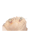 Anatomical Implant Restoration Crown